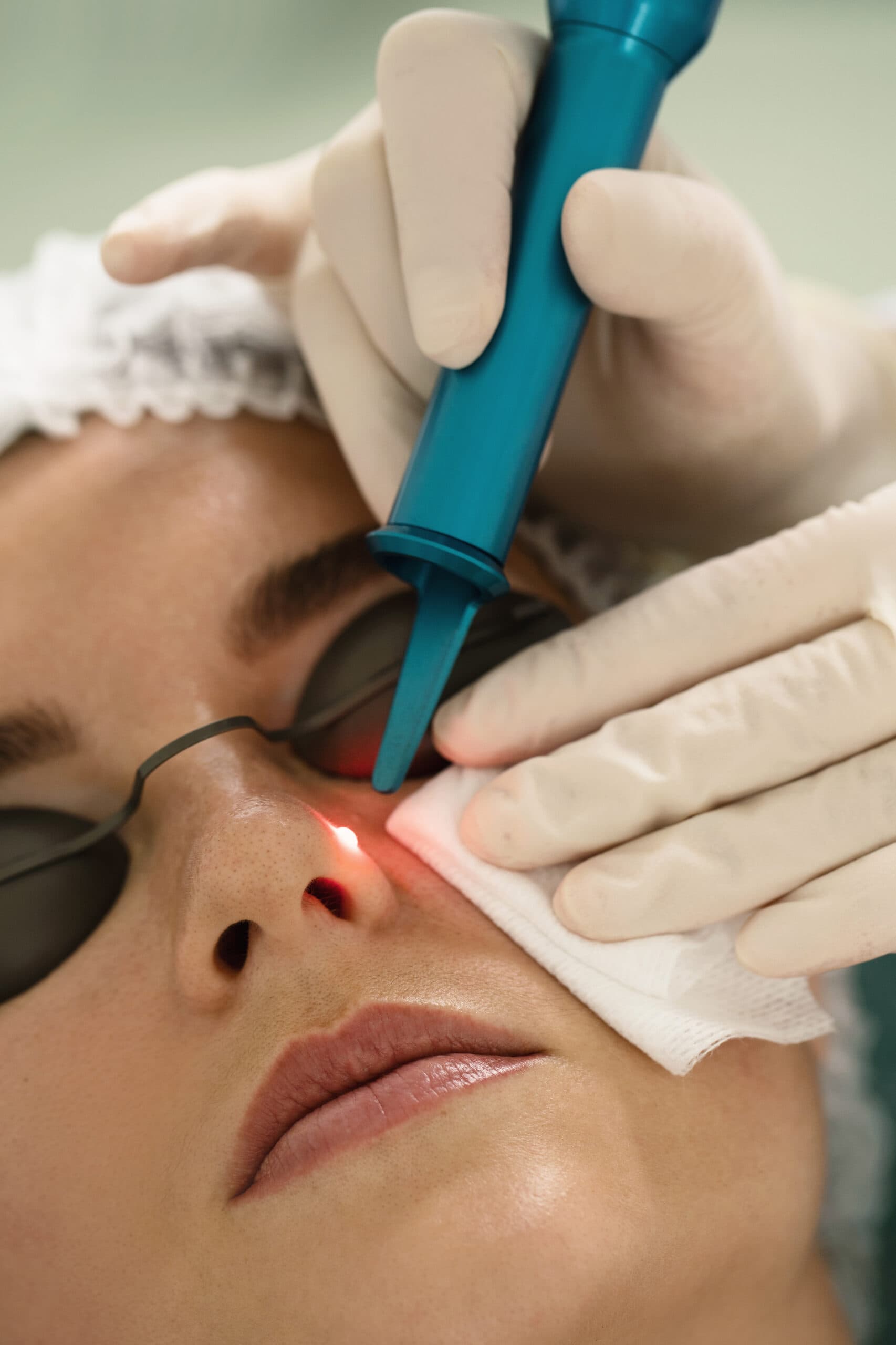 Mole removal procedure at a medical aesthetic clinic