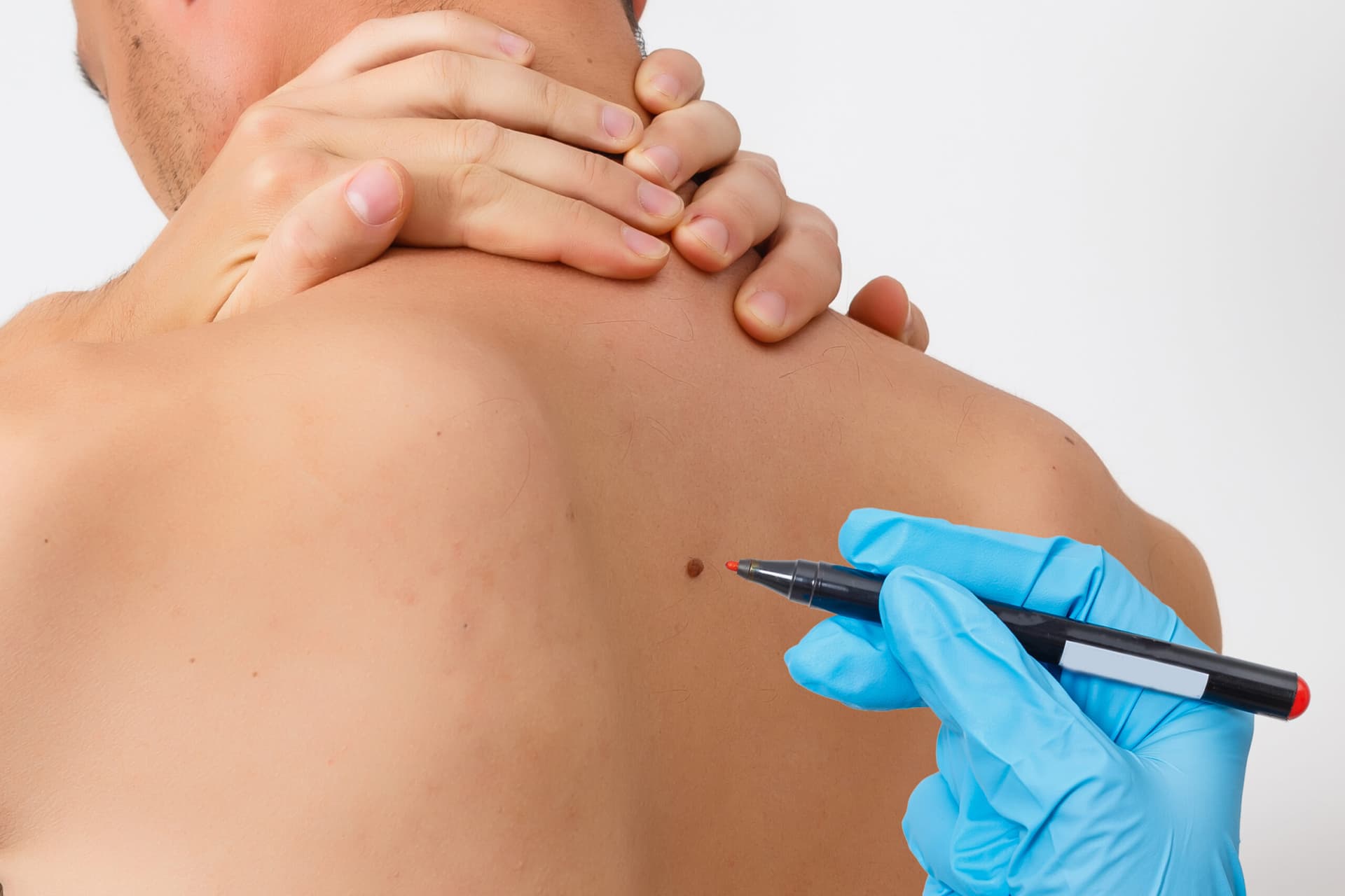 Mole removal procedure at a medical aesthetic clinic